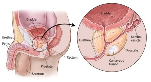 cancer prostata etapa 7