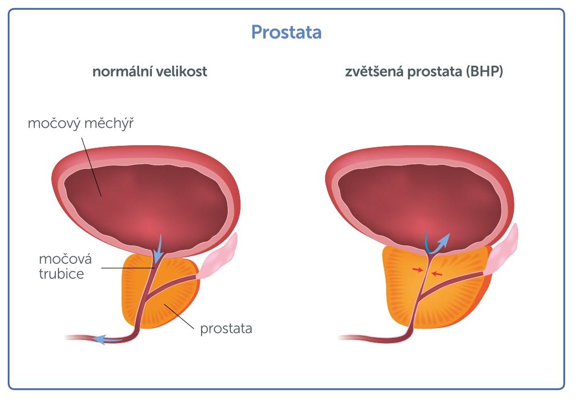 Prostate Hyperplasia Prosztata kalcinál