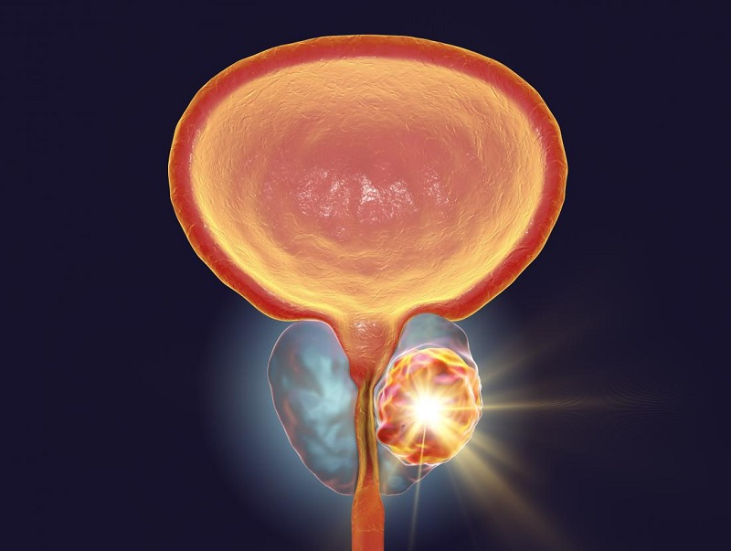 Prostate Hyperplasia Prosztata kalcinál)