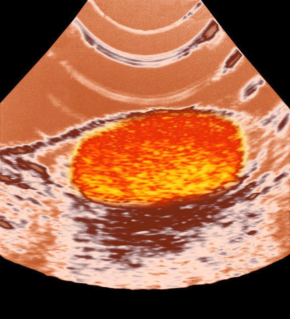 ultrazvukové vyšetření nádoru varlat